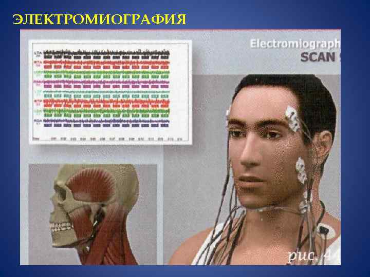 ЭЛЕКТРОМИОГРАФИЯ 