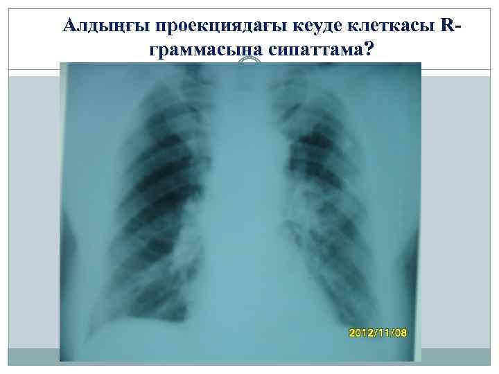 Алдыңғы проекциядағы кеуде клеткасы Rграммасына сипаттама? 