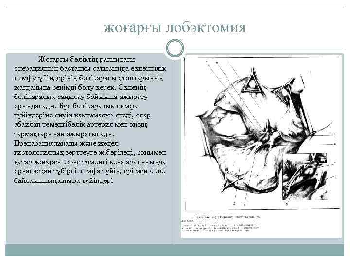 жоғарғы лобэктомия Жоғарғы бөліктің рагындағы операцияның бастапқы сатысында өкпеішілік лимфатүйіндерінің бөлікаралық топтарының жағдайына сенімді