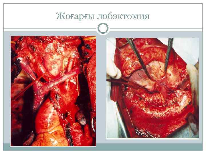 Жоғарғы лобэктомия 