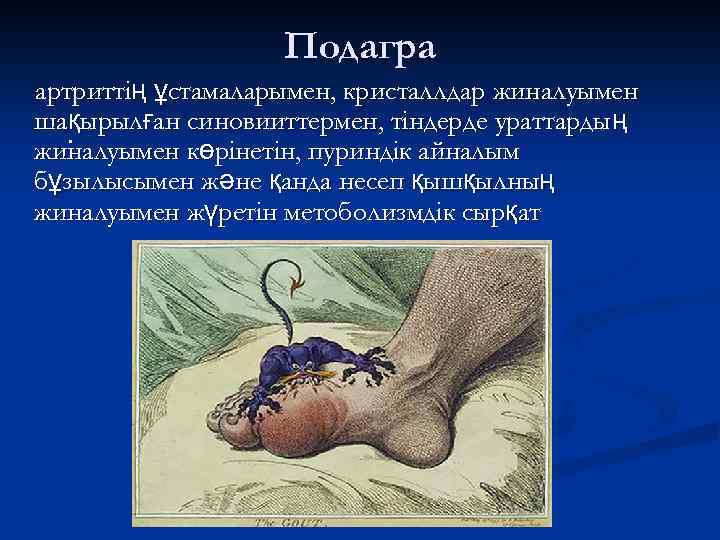 Подагра артриттің ұстамаларымен, кристаллдар жиналуымен шақырылған синовииттермен, тіндерде ураттардың. жиналуымен көрінетін, пуриндік айналым бұзылысымен