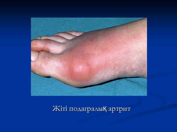 Жіті подагралық артрит 
