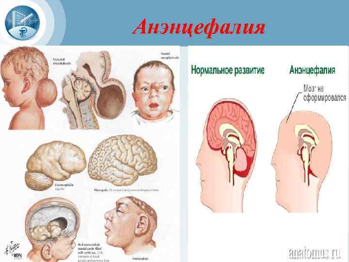 Анэнцефалия 