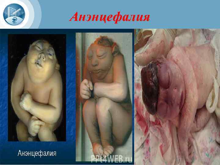 Анэнцефалия 