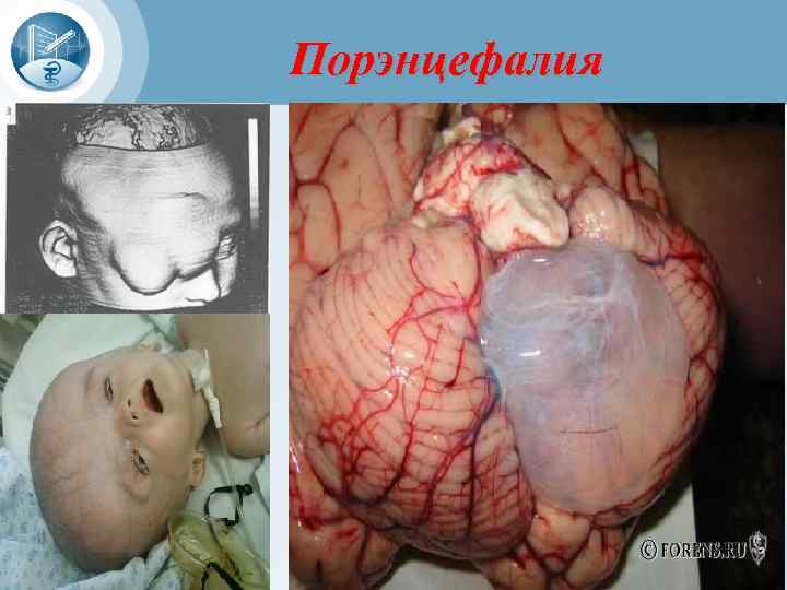 Порэнцефалия 