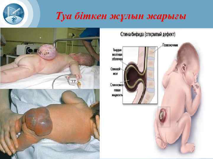 Туа біткен жұлын жарығы 