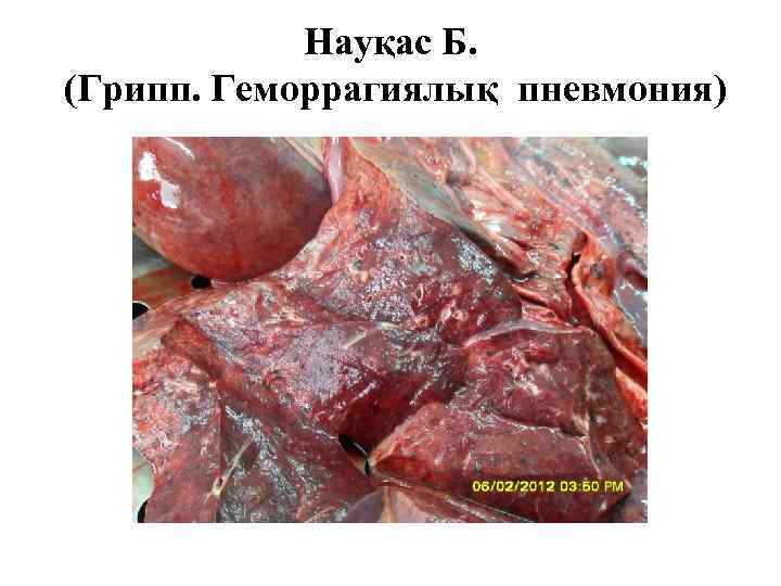   Науқас Б. (Грипп. Геморрагиялық пневмония) 