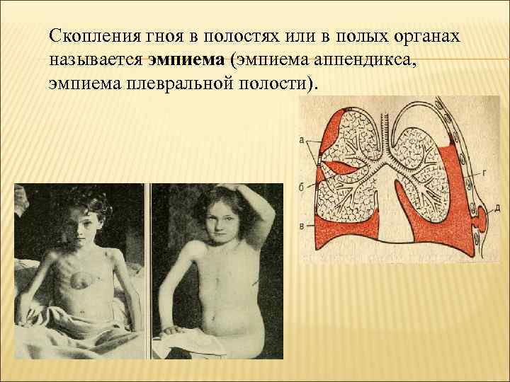 Скопления гноя в полостях или в полых органах называется эмпиема (эмпиема аппендикса, эмпиема плевральной