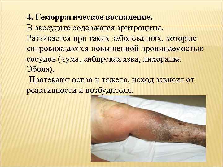 4. Геморрагическое воспаление. В экссудате содержатся эритроциты. Развивается при таких заболеваниях, которые сопровождаются повышенной