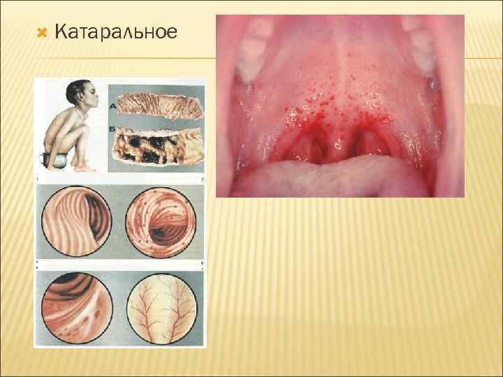  Катаральное 