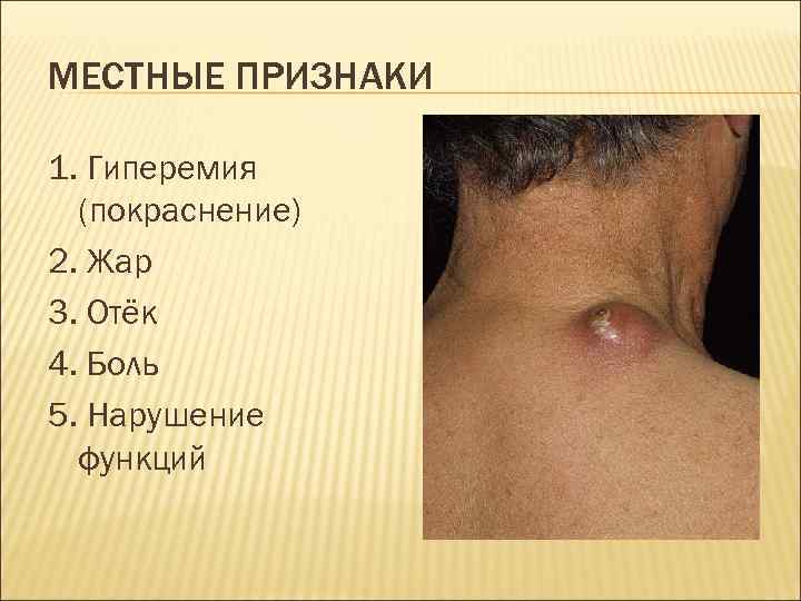 МЕСТНЫЕ ПРИЗНАКИ 1. Гиперемия (покраснение) 2. Жар 3. Отёк 4. Боль 5. Нарушение функций