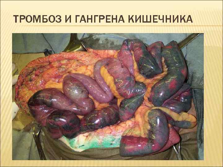 ТРОМБОЗ И ГАНГРЕНА КИШЕЧНИКА 