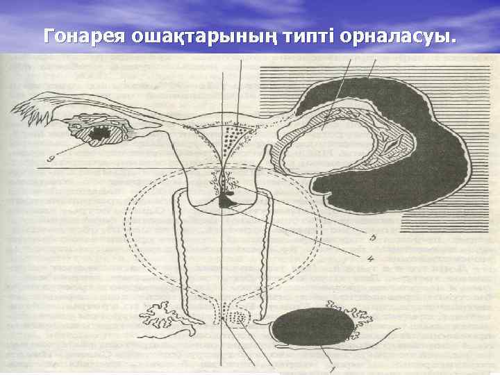 Гонарея ошақтарының типті орналасуы. 