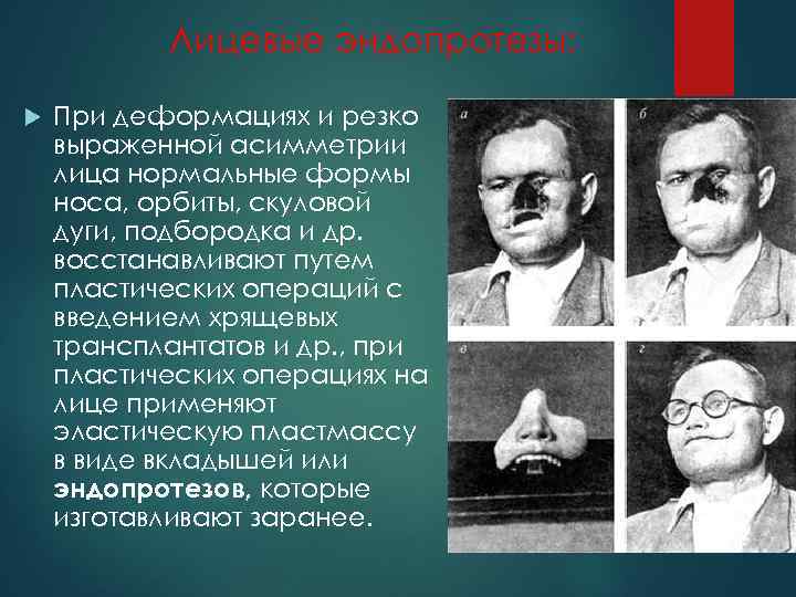 Лицевые эндопротезы: При деформациях и резко выраженной асимметрии лица нормальные формы носа, орбиты, скуловой