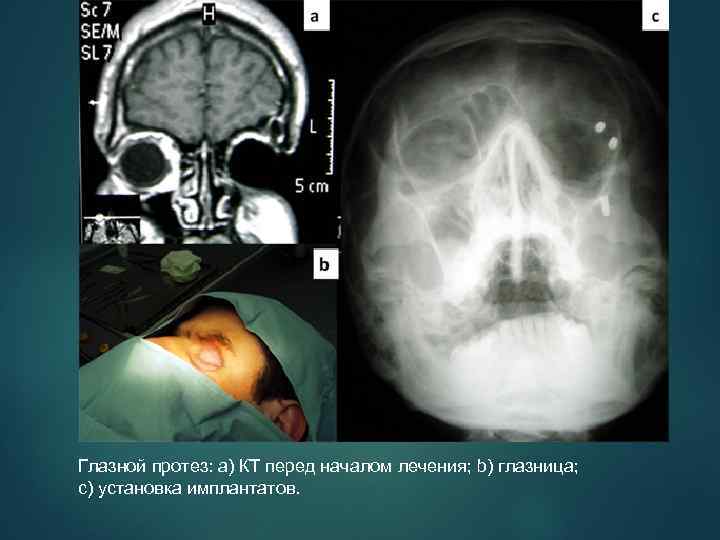 Глазной протез: a) КT перед началом лечения; b) глазница; c) установка имплантатов. 