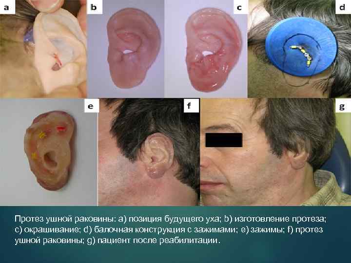 Протез ушной раковины: a) позиция будущего уха; b) изготовление протеза; c) окрашивание; d) балочная
