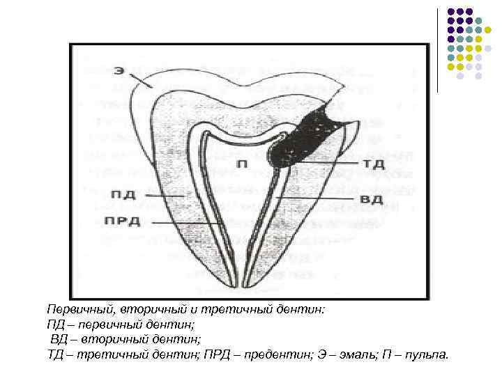 Первичный, вторичный и третичный дентин: ПД – первичный дентин; ВД – вторичный дентин; ТД