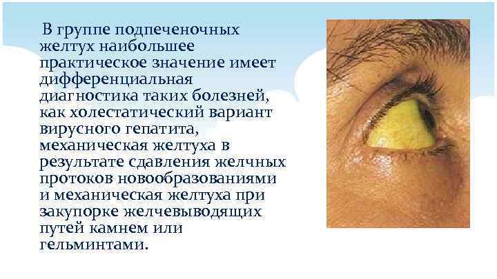 В группе подпеченочных желтух наибольшее практическое значение имеет дифференциальная диагностика таких болезней, как холестатический