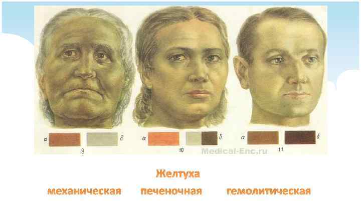 механическая Желтуха печеночная гемолитическая 