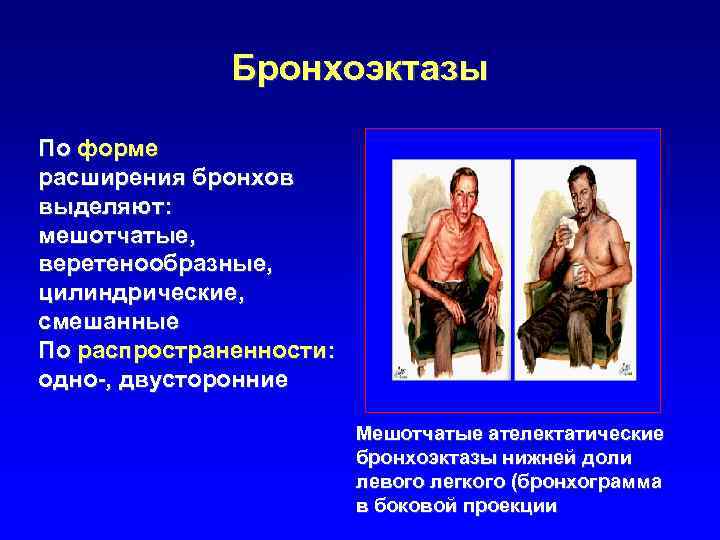 Бронхоэктазы По форме расширения бронхов выделяют: мешотчатые, веретенообразные, цилиндрические, смешанные По распространенности: одно-, двусторонние
