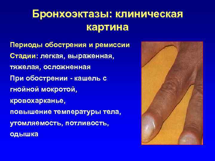 Бронхоэктазы: клиническая картина Периоды обострения и ремиссии Стадии: легкая, выраженная, тяжелая, осложненная При обострении