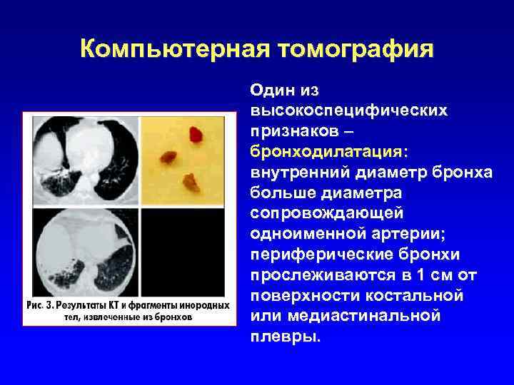Компьютерная томография Один из высокоспецифических признаков – бронходилатация: внутренний диаметр бронха больше диаметра сопровождающей