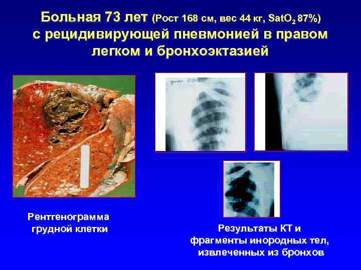 Больная 73 лет (Рост 168 см, вес 44 кг, Sat. O 2 87%) с