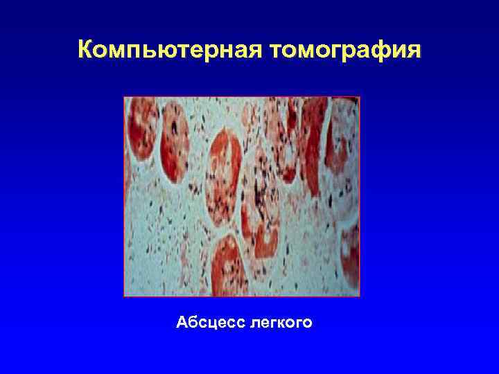 Компьютерная томография Абсцесс легкого 