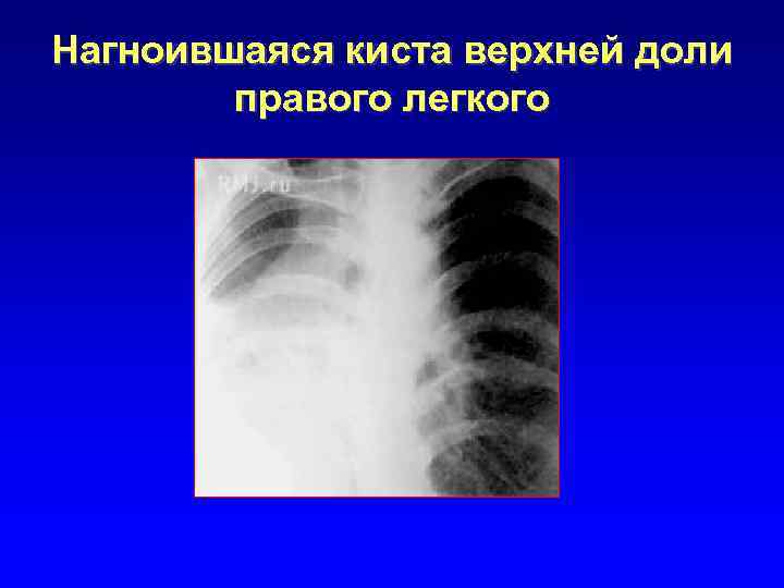 Нагноившаяся киста верхней доли правого легкого 