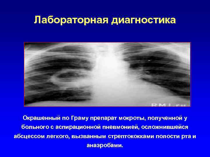 Лабораторная диагностика Окрашенный по Граму препарат мокроты, полученной у больного с аспирационной пневмонией, осложнившейся