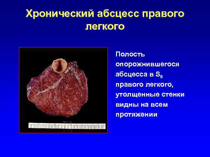Хронический абсцесс правого легкого Полость опорожнившегося абсцесса в S 6 правого легкого, утолщенные стенки
