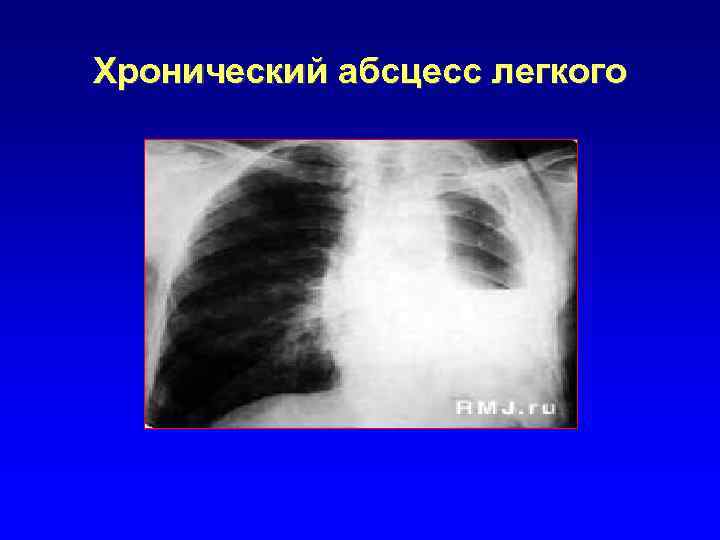 Хронический абсцесс легкого 