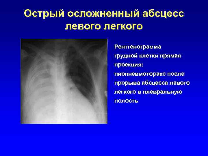 Рентгенологическая картина при абсцессе