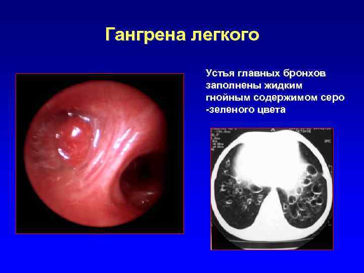 Гангрена легкого Устья главных бронхов заполнены жидким гнойным содержимом серо -зеленого цвета 