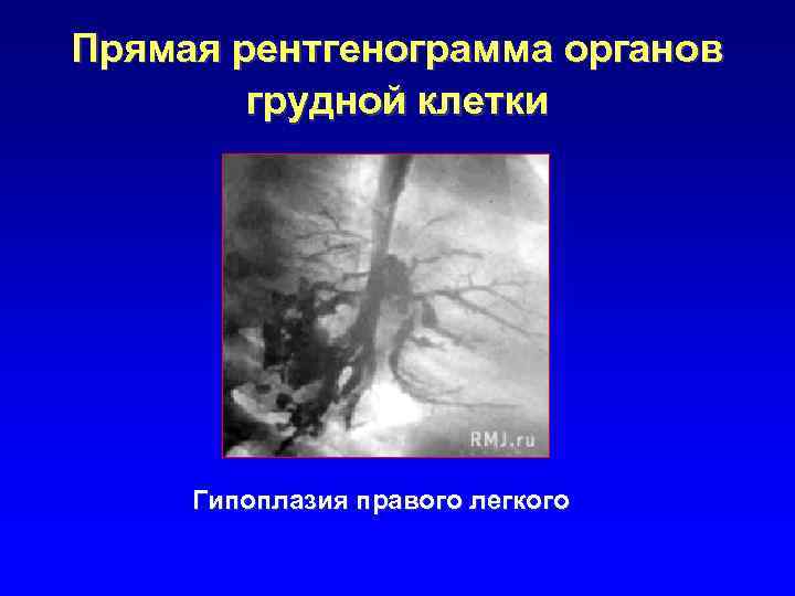 Прямая рентгенограмма органов грудной клетки Гипоплазия правого легкого 