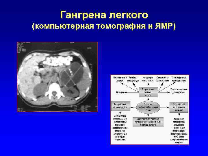 Гангрена легкого (компьютерная томография и ЯМР) 