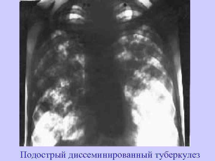 Подострый диссеминированный туберкулез 