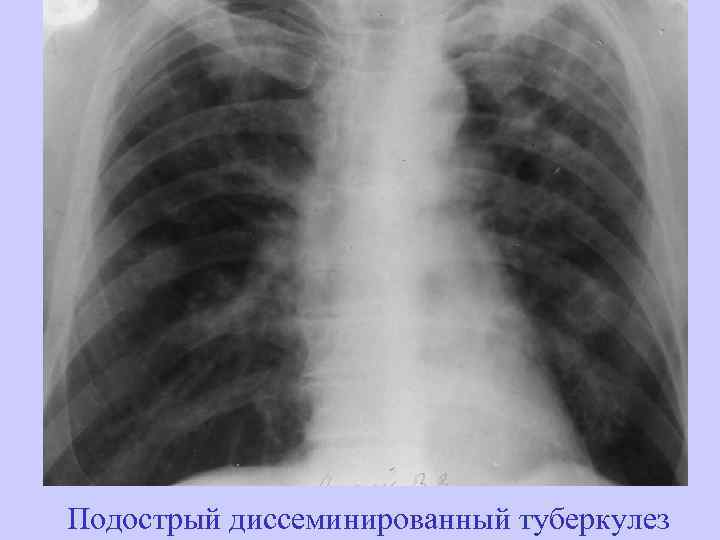 Подострый диссеминированный туберкулез 