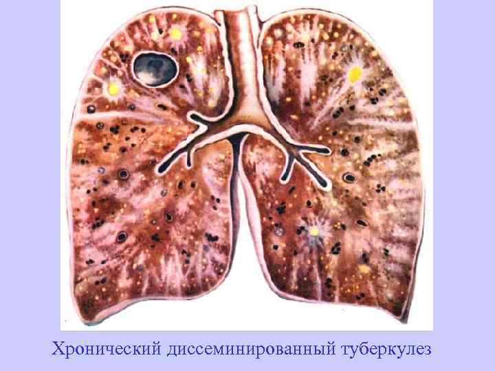 Хронический диссеминированный туберкулез 