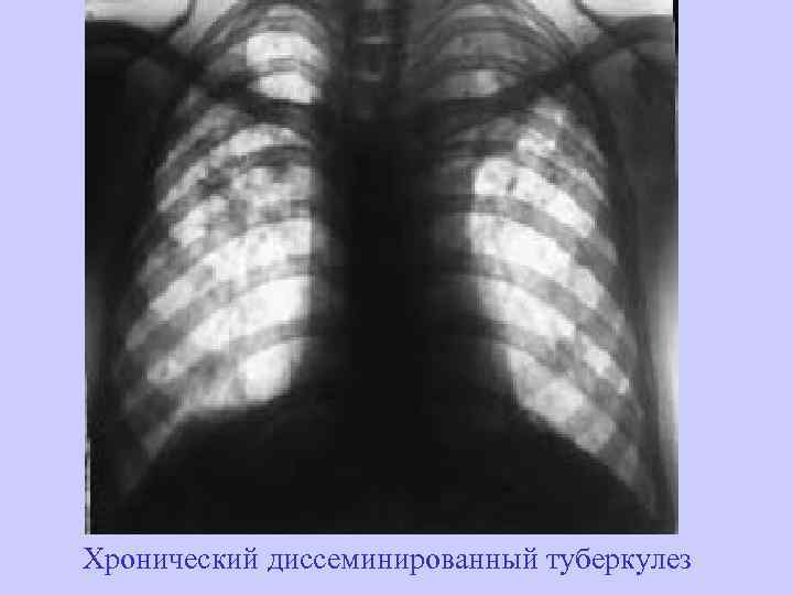 Хронический диссеминированный туберкулез 