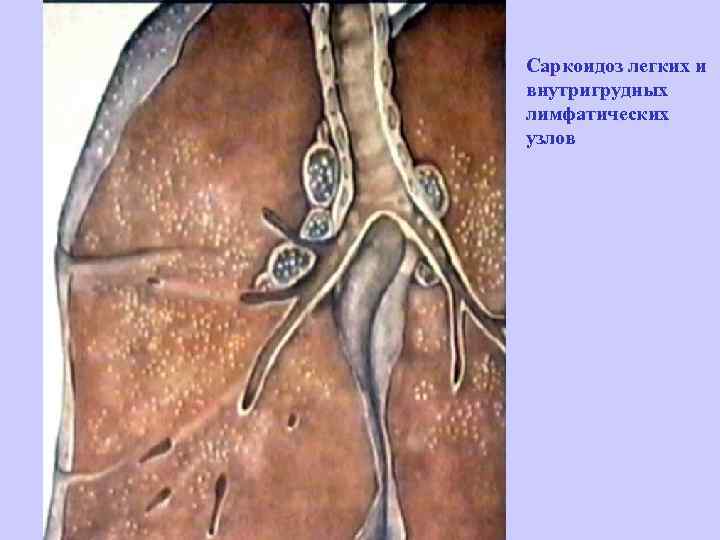 Саркоидоз легких и внутригрудных лимфатических узлов 