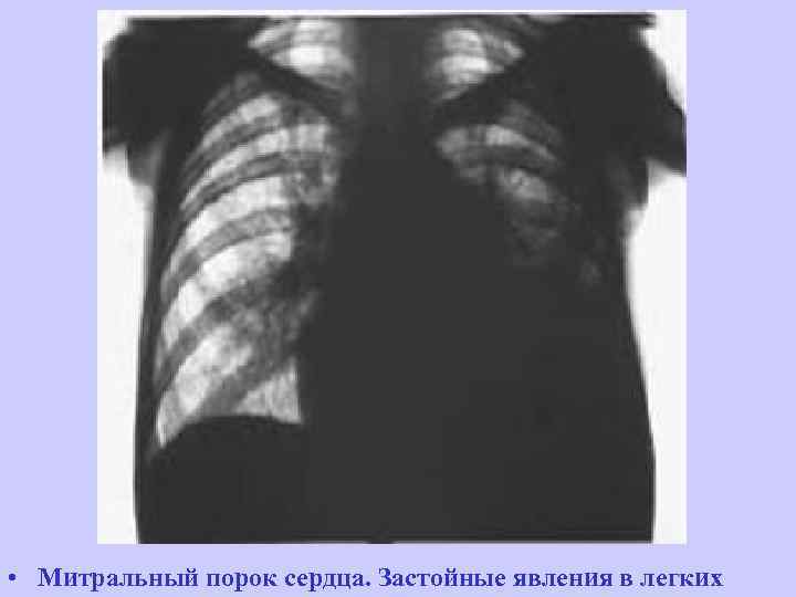  • Митральный порок сердца. Застойные явления в легких 