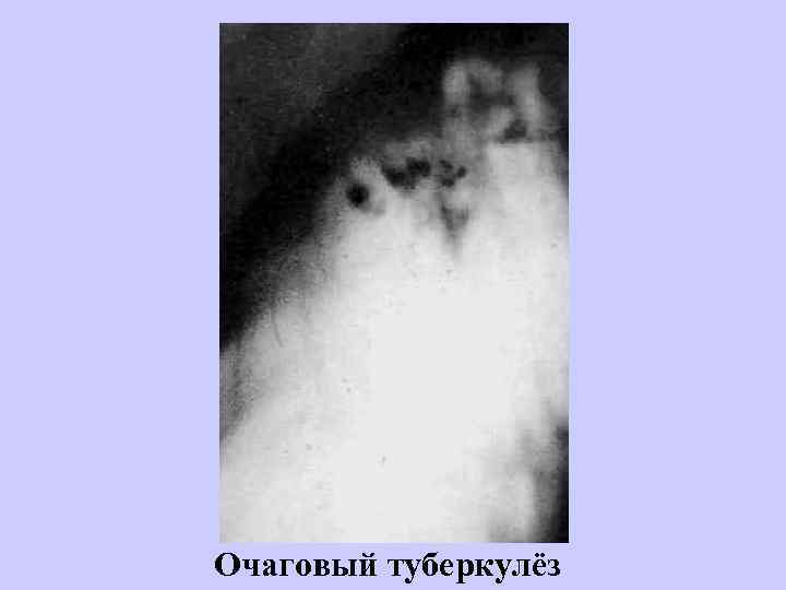 Очаговый туберкулёз 