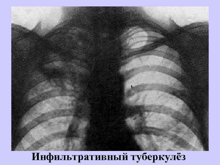 Инфильтративный туберкулёз 