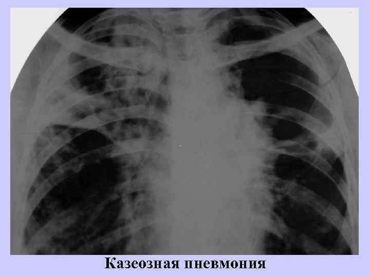 Казеозная пневмония 