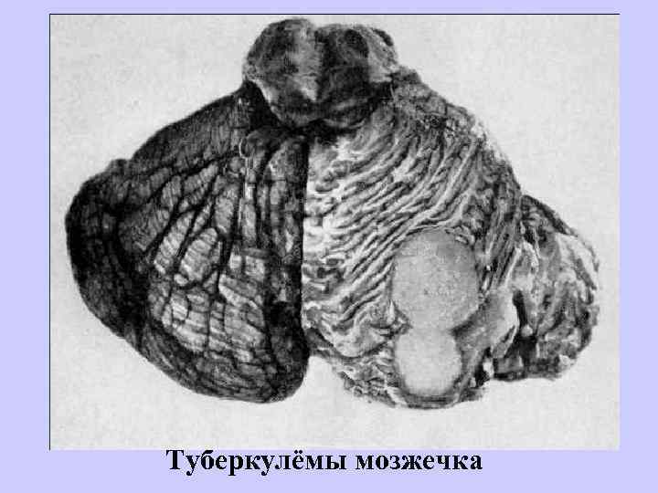 Туберкулёмы мозжечка 