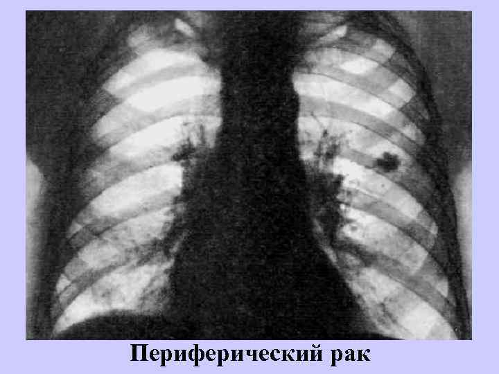 Периферический рак 