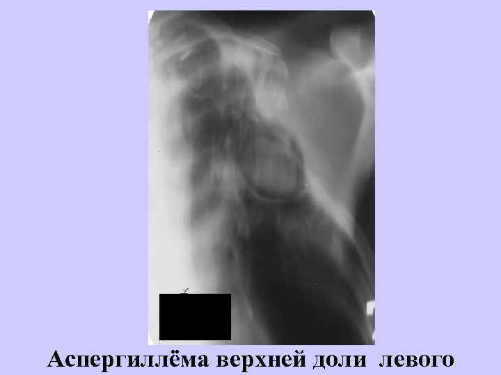 Аспергиллёма верхней доли левого 