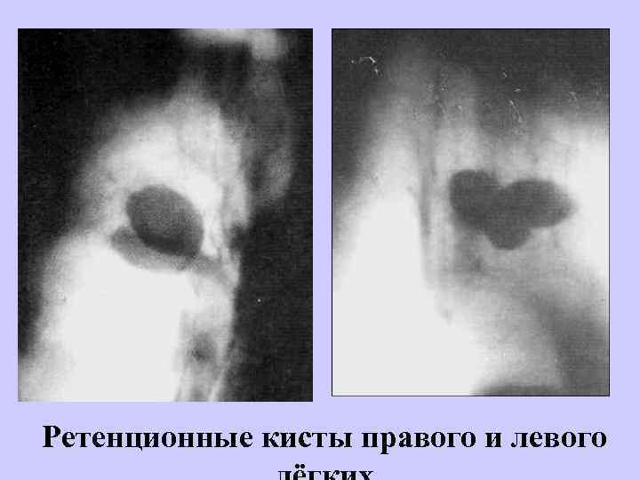 Ретенционные кисты правого и левого 