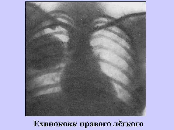Ехинококк правого лёгкого 
